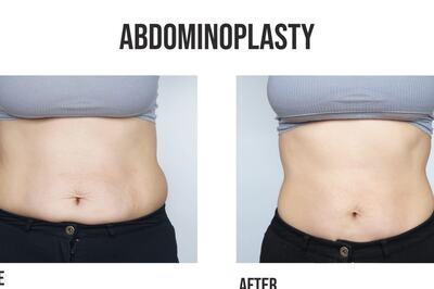 Tummy Tuck Procedures for Postpartum Body Restoration: Reducing Belly Fat