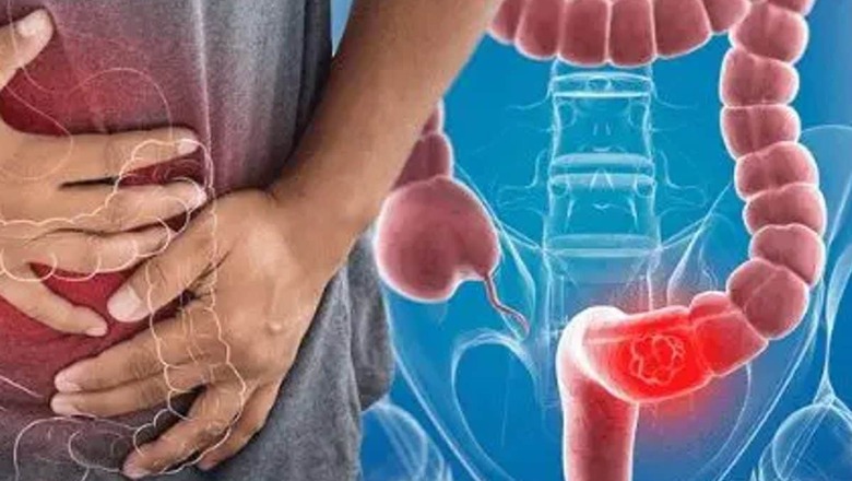 Early Indicators of Bowel Cancer That You Should Not Overlook