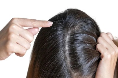 UK Woman Faces Baldness Due To Hair Extensions; Here’s How to Protect Your Tresses From Damage