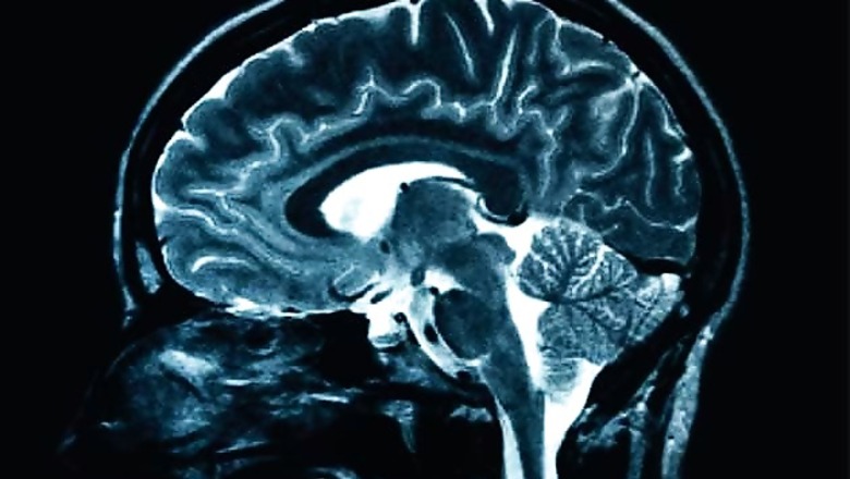 Brain injury may be present even without symptoms