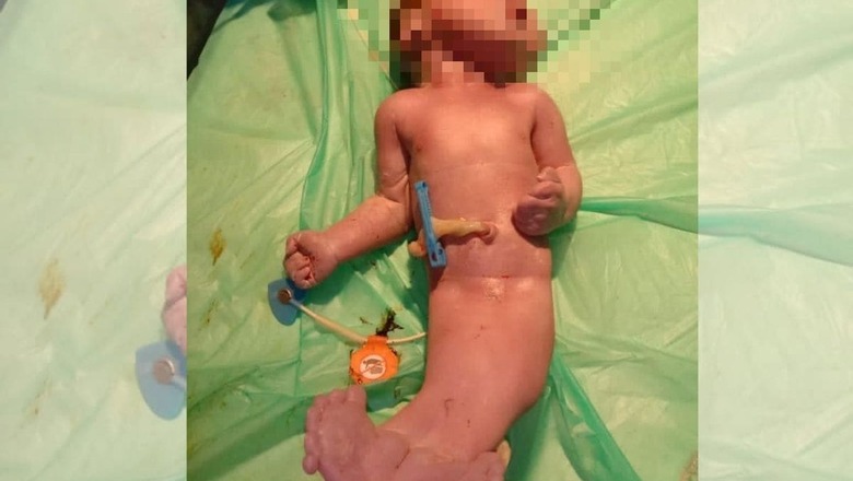 Baby Born with 'Mermaid Syndrome' in Hyderabad Dies Within Hours of Birth