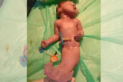 Baby Born with 'Mermaid Syndrome' in Hyderabad Dies Within Hours of Birth