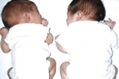 Twist in the 'tall' tale: think twins!