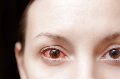 ‘Conjunctivitis Surge an Epidemic’: Doctors Say Infections Likely to Peak Soon | All You Need to Know