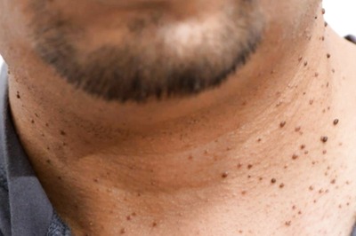 Are Warts Troubling You? Here are Easy Home Remedies to Get Rid of Them