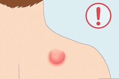 How to Remove a Sebaceous Cyst
