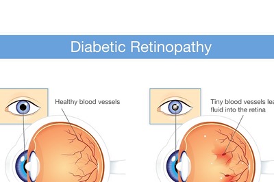 Eye complications that you should know about, if you live with diabetes.