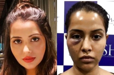 Tamil Actress Raiza Wilson Forced to Undergo Dermatological Treatment, Shares Pic After it Goes Wrong
