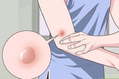 How to Handle a Rheumatoid Arthritis Skin Problem