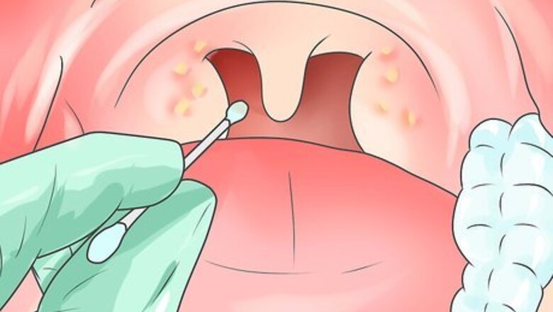 How to Treat Bacterial Pharyngitis