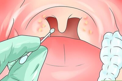 How to Treat Bacterial Pharyngitis