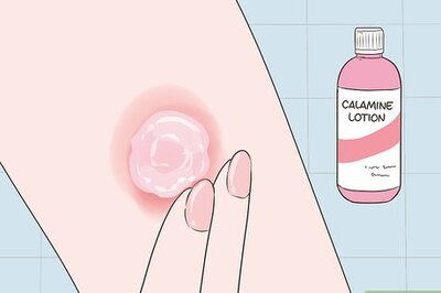 How to Treat Poison Ivy Blisters