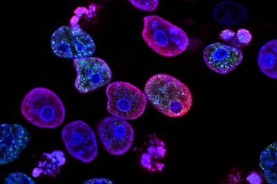 Multiple Myeloma and What the Treatment Entails