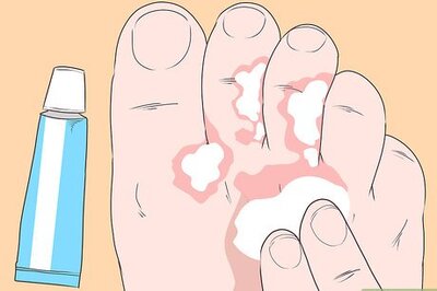 How to Stop Itching Caused by Athlete's Foot