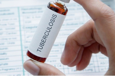 Tuberculosis can Induce Premature Cellular Ageing