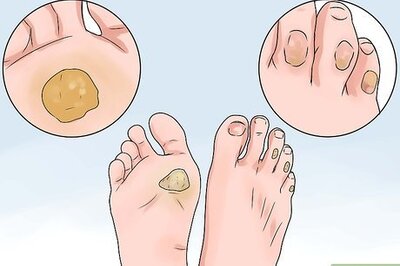 How to Treat a Corn or Callus