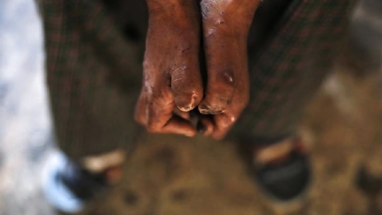 India Needs to Boost Vigil Against Leprosy Cases in Remote Areas, Says WHO Ambassador