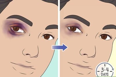 How to Cover a Black Eye