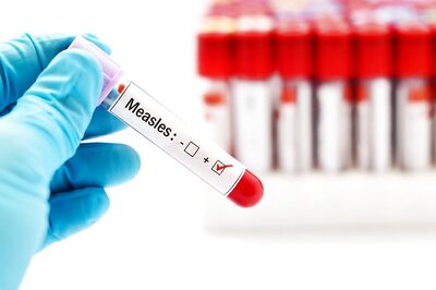 Measles: One More Child Dies in Mumbai, Toll at 11; Case Tally Rises to 220