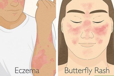 How to Tell Eczema from Butterfly Rash