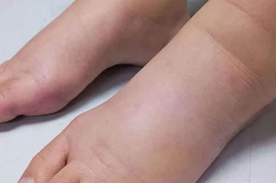 Swells To Blisters, Understanding And Preventing Cold Sores In Chilly Weather