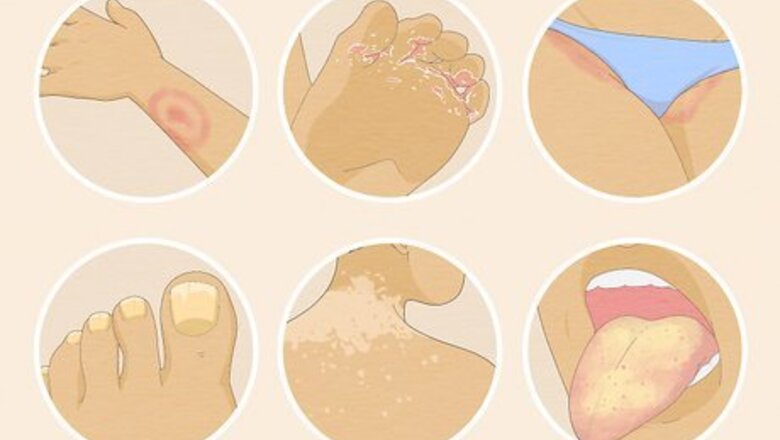 How to Treat Fungal Rash