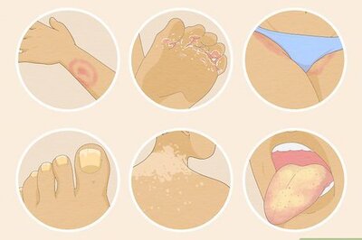 How to Treat Fungal Rash