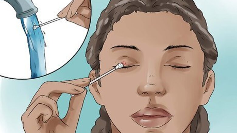 How to Get Rid Of a Stye