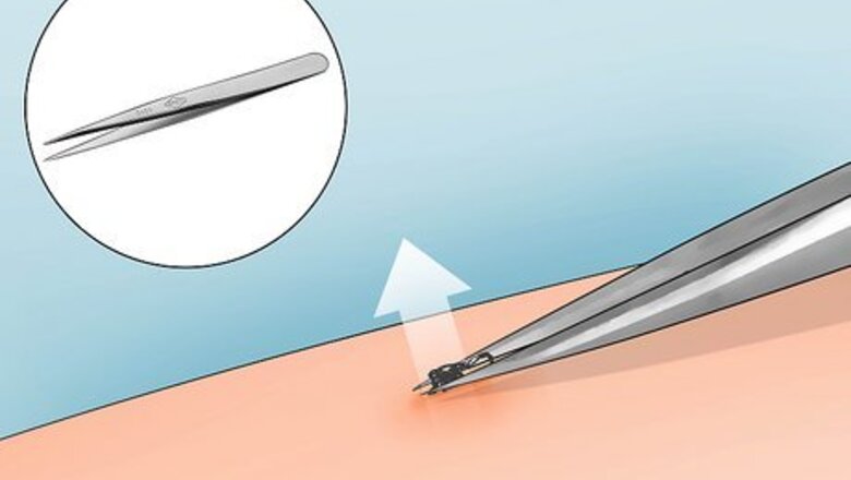 How to Remove an Embedded Tick Head