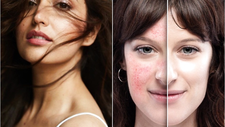 Keratosis Pilaris: Everything You Need to Know About the Skin Disease Yami Gautam is Battling With