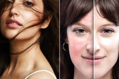 Keratosis Pilaris: Everything You Need to Know About the Skin Disease Yami Gautam is Battling With