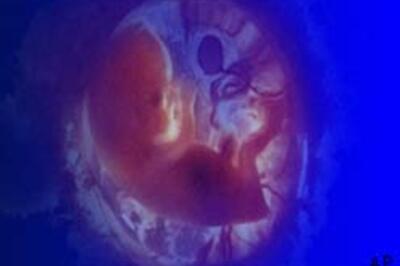 Triplets for woman with two wombs