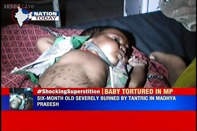 MP: Tantrik presses hot iron sickle to 6-month-old baby to cure her of pneumonia