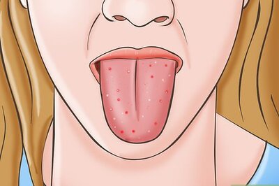 How to Know if You Have Oral Thrush