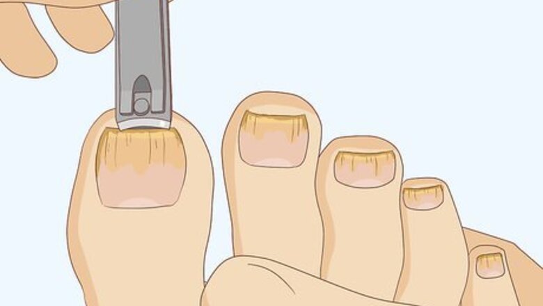 How to Cure Toenail Fungus: Can Vinegar Help?