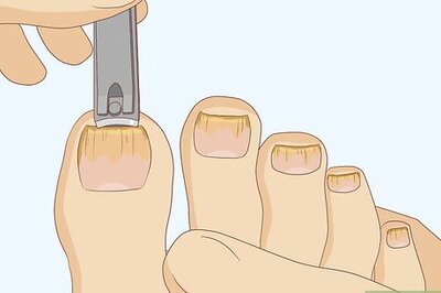 How to Cure Toenail Fungus: Can Vinegar Help?