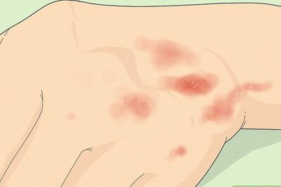 How to Identify Scabies: Symptoms, Treatment, Diagnosis, & More
