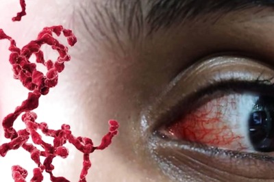 'Medication Stopped Working': Chinese Man Loses One Eye After Firefly Sat On His Face