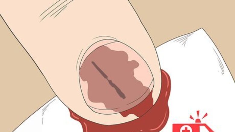 How to Remove a Splinter Under Your Fingernail