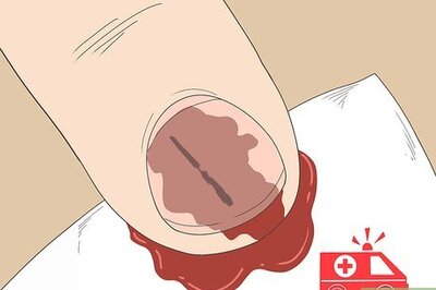 How to Remove a Splinter Under Your Fingernail