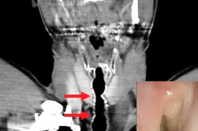 54-year-old Austrian Man Gets Hair Growth Inside Throat Due To Smoking